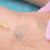 Curso de Peim- Procedimento Estético Injetável para Microvasos