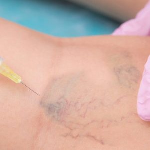 Curso de Peim- Procedimento Estético Injetável para Microvasos