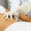 Curso de Hidrolipoclasia Não Aspirativa Ultrassonica